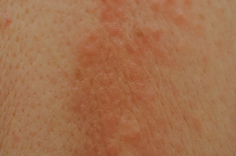 Rote Punkte auf der Haut jucken-Ursachen
